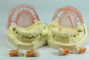 牙周病模型
